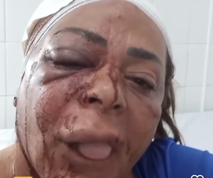 “Quase me matou”: Moradora de Japaratuba denuncia ter sido espancada pelo companheiro e clama por justiça 